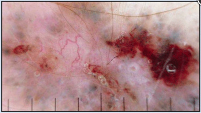 basalzellkarzinom_mit_gefaessen_und_blaugrauen_schollen.png