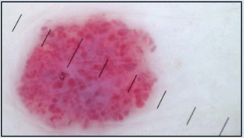 haemangiom.png haemangiom.png